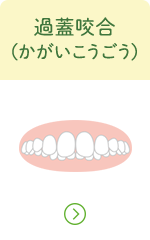 過蓋咬合へのリンクボタン