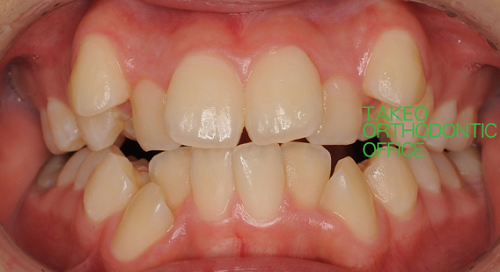一期治療時(上顎急速側方拡大装置使用中)